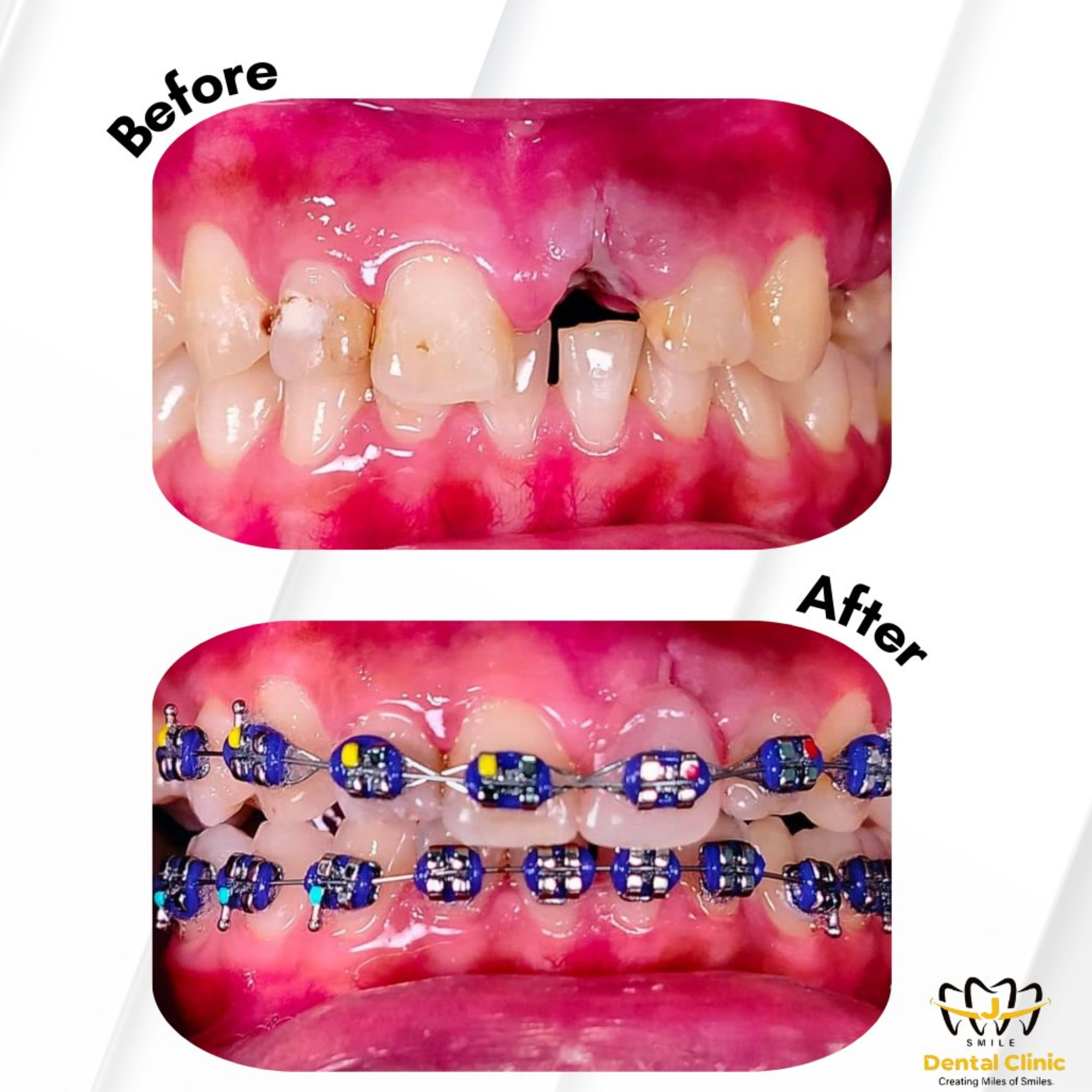 Orthodontic braces result: crowded teeth and gap corrected at JSmile Dental Clinic