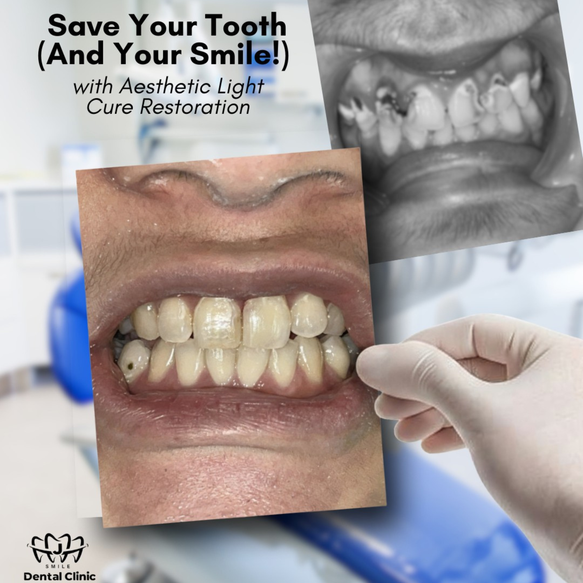 Aesthetic light cure composite restoration at JSmile Dental Clinic