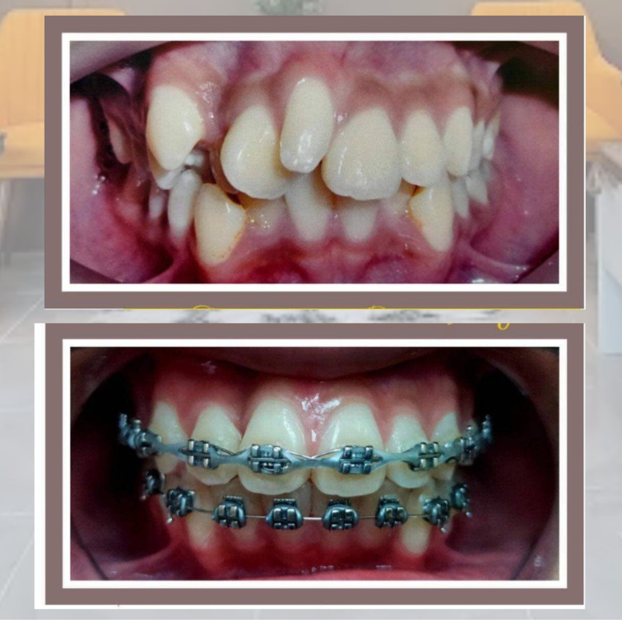 Orthodontic braces result: overlapping teeth realigned at JSmile Dental Clinic