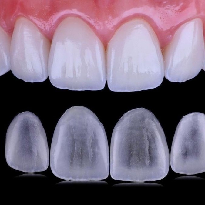 Composite Veneers