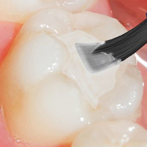 Dental Sealants