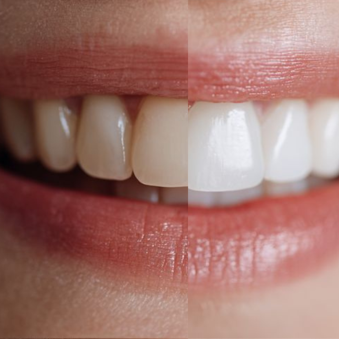 Teeth Whitening