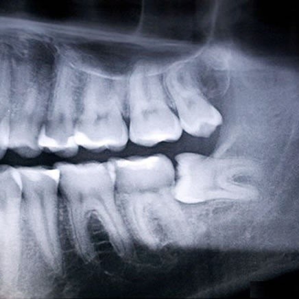 Digital Dental X-Ray